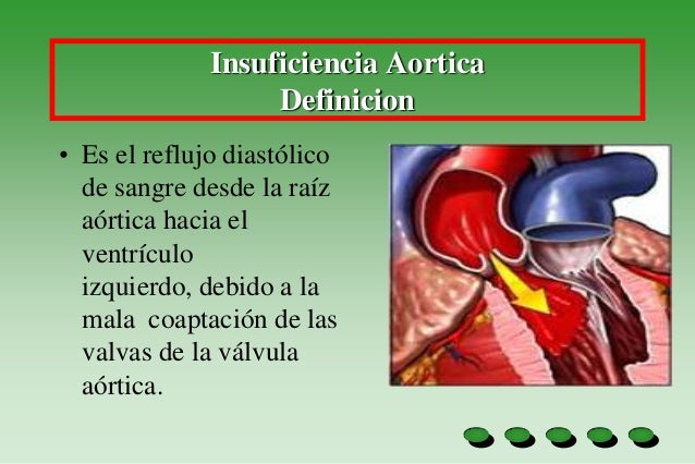 insuficiencia aortica